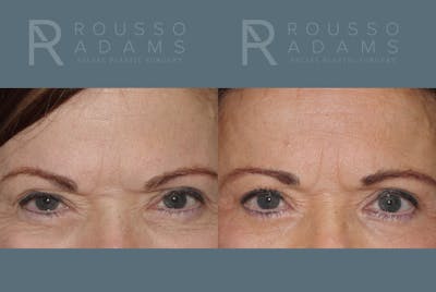 Blepharoplasty <span class=small>By Dr. Daniel Rousso</span> Before & After Gallery - Patient 610638 - Image 1