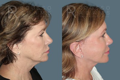 Facelift <span class=small>By Dr. Daniel Rousso</span> Before & After Gallery - Patient 391094 - Image 2