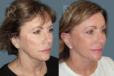 Facelift <span class=small>By Dr. Daniel Rousso</span> Before & After Gallery - Patient 391094 - Image 1