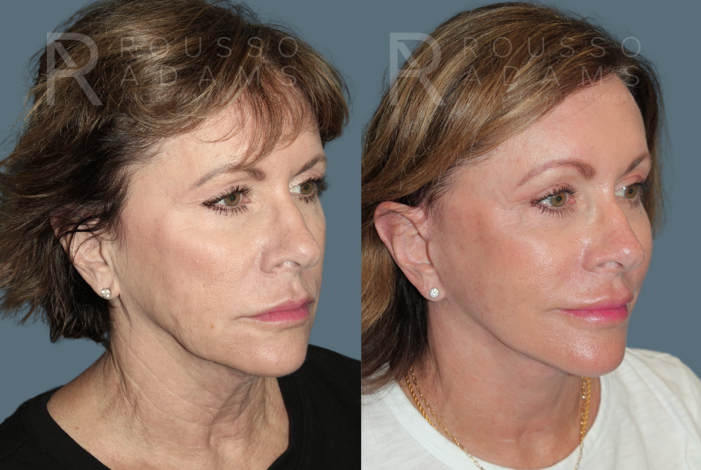 Facelift <span class=small>By Dr. Daniel Rousso</span> Before & After Gallery - Patient 391094 - Image 1
