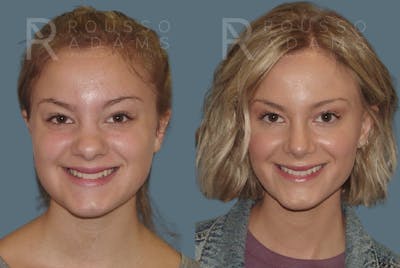 Rhinoplasty <span class=small>By Dr. Daniel Rousso</span> Before & After Gallery - Patient 235075 - Image 1