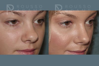 Rhinoplasty <span class=small>By Dr. Daniel Rousso</span> Before & After Gallery - Patient 235075 - Image 4