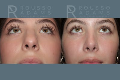Rhinoplasty <span class=small>By Dr. Daniel Rousso</span> Before & After Gallery - Patient 307078 - Image 2