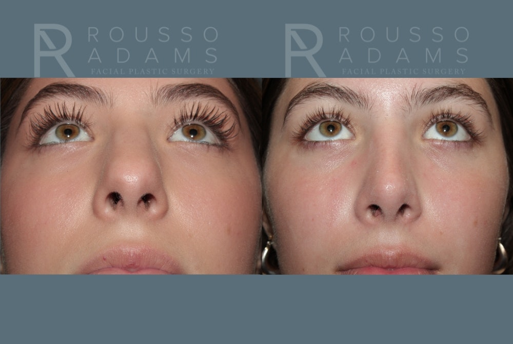 Rhinoplasty <span class=small>By Dr. Daniel Rousso</span> Before & After Gallery - Patient 307078 - Image 2