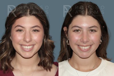 Rhinoplasty <span class=small>By Dr. Daniel Rousso</span> Before & After Gallery - Patient 307078 - Image 1