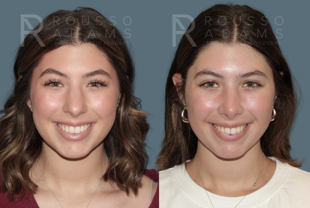 Rhinoplasty <span class=small>By Dr. Daniel Rousso</span> Before & After Gallery - Patient 307078 - Image 3