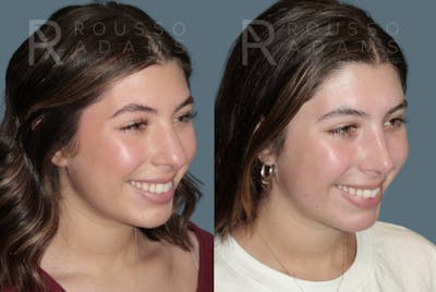 Rhinoplasty <span class=small>By Dr. Daniel Rousso</span> Before & After Gallery - Patient 307078 - Image 4