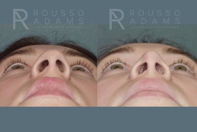 Rhinoplasty <span class=small>By Dr. Daniel Rousso</span> Before & After Gallery - Patient 219127 - Image 4