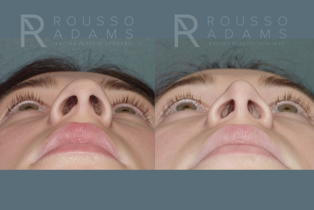Rhinoplasty <span class=small>By Dr. Daniel Rousso</span> Before & After Gallery - Patient 219127 - Image 4