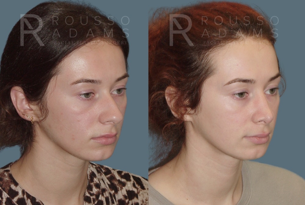 Rhinoplasty <span class=small>By Dr. Daniel Rousso</span> Before & After Gallery - Patient 219127 - Image 3