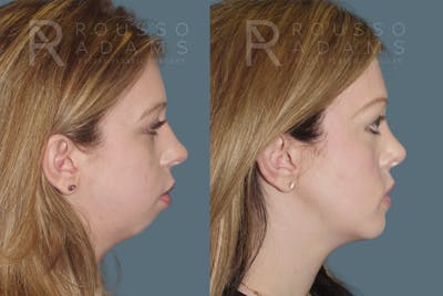 Rhinoplasty <span class=small>By Dr. Daniel Rousso</span> Before & After Gallery - Patient 344988 - Image 1