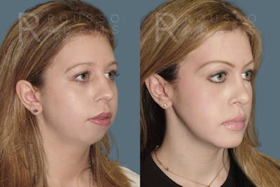Rhinoplasty <span class=small>By Dr. Daniel Rousso</span> Before & After Gallery - Patient 344988 - Image 2