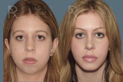 Rhinoplasty <span class=small>By Dr. Daniel Rousso</span> Before & After Gallery - Patient 344988 - Image 1