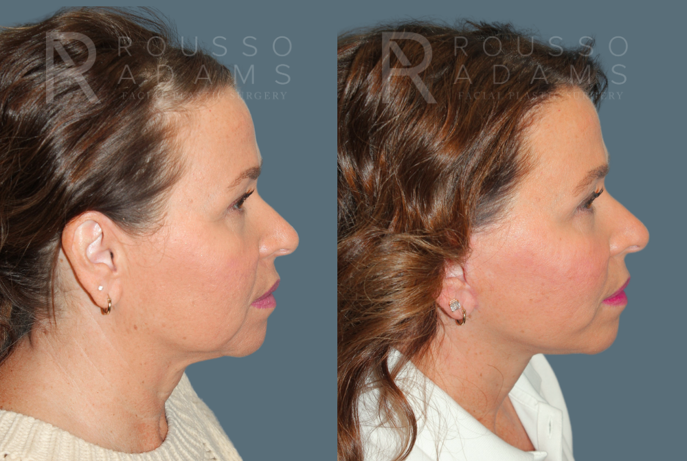 SculptLift™ <span class=small>By Dr. Daniel Rousso</span> Before & After Gallery - Patient 367804 - Image 2