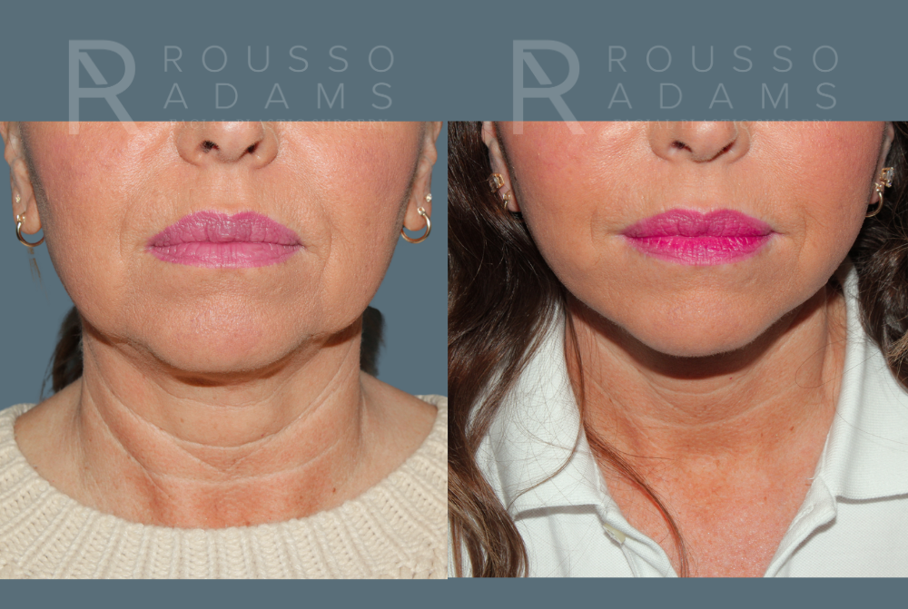 SculptLift™ <span class=small>By Dr. Daniel Rousso</span> Before & After Gallery - Patient 367804 - Image 3