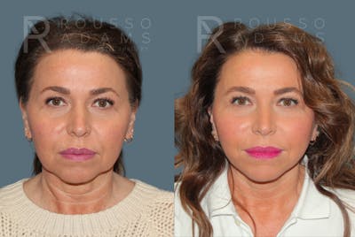 SculptLift™ <span class=small>By Dr. Daniel Rousso</span> Before & After Gallery - Patient 367804 - Image 1