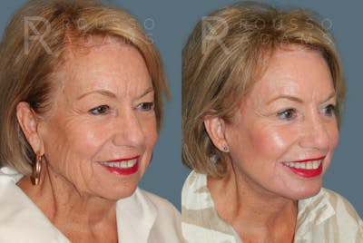 SculptLift™ <span class=small>By Dr. Daniel Rousso</span> Before & After Gallery - Patient 714208 - Image 2