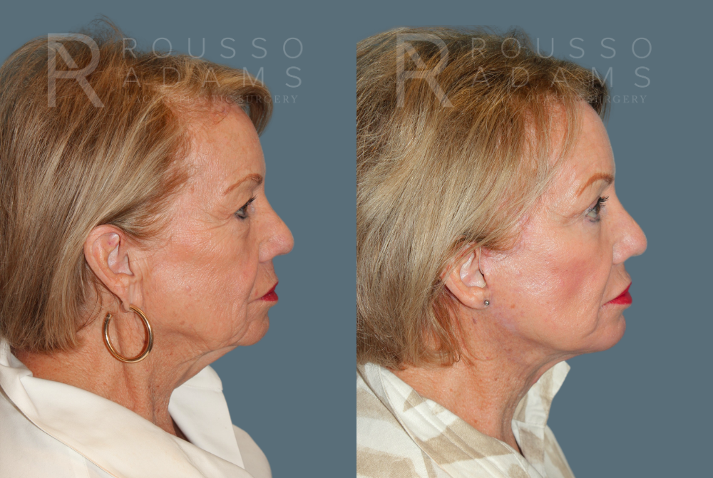 SculptLift™ <span class=small>By Dr. Daniel Rousso</span> Before & After Gallery - Patient 714208 - Image 3