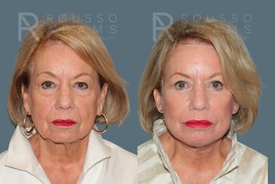 SculptLift™ <span class=small>By Dr. Daniel Rousso</span> Before & After Gallery - Patient 714208 - Image 1