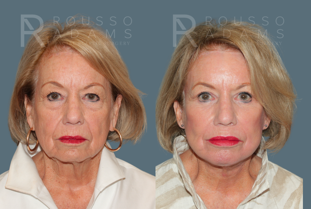 SculptLift™ <span class=small>By Dr. Daniel Rousso</span> Before & After Gallery - Patient 714208 - Image 1