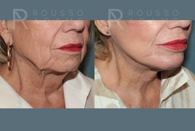 SculptLift™ <span class=small>By Dr. Daniel Rousso</span> Before & After Gallery - Patient 714208 - Image 4