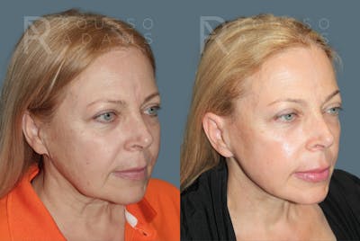 SculptLift™ <span class=small>By Dr. Daniel Rousso</span> Before & After Gallery - Patient 215754 - Image 1
