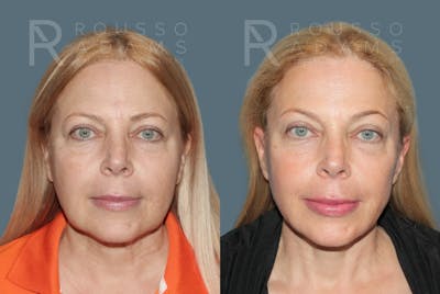 SculptLift™ <span class=small>By Dr. Daniel Rousso</span> Before & After Gallery - Patient 215754 - Image 2