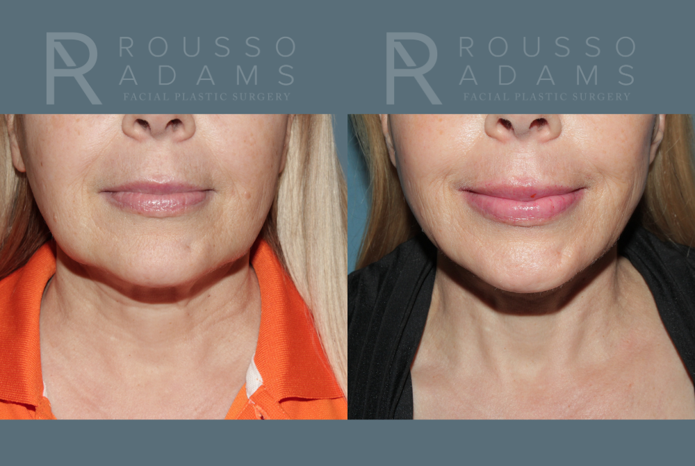 SculptLift™ <span class=small>By Dr. Daniel Rousso</span> Before & After Gallery - Patient 215754 - Image 3