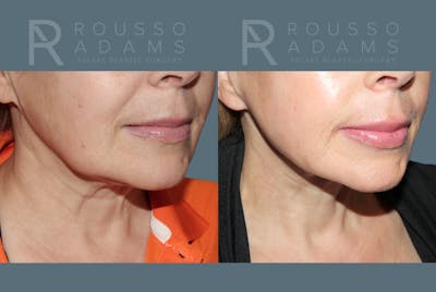 SculptLift™ <span class=small>By Dr. Daniel Rousso</span> Before & After Gallery - Patient 215754 - Image 4