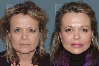 SculptLift™ <span class=small>By Dr. Daniel Rousso</span> Before & After Gallery - Patient 350743 - Image 1
