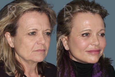 SculptLift™ <span class=small>By Dr. Daniel Rousso</span> Before & After Gallery - Patient 350743 - Image 2