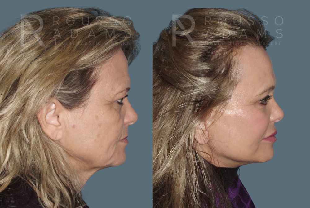SculptLift™ <span class=small>By Dr. Daniel Rousso</span> Before & After Gallery - Patient 350743 - Image 3