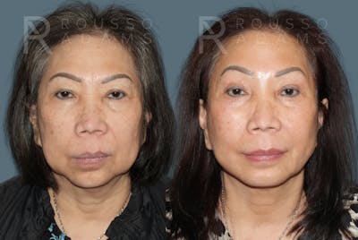 SculptLift™ <span class=small>By Dr. Daniel Rousso</span> Before & After Gallery - Patient 249261 - Image 1