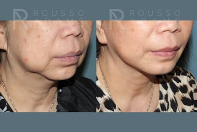 SculptLift™ <span class=small>By Dr. Daniel Rousso</span> Before & After Gallery - Patient 249261 - Image 2