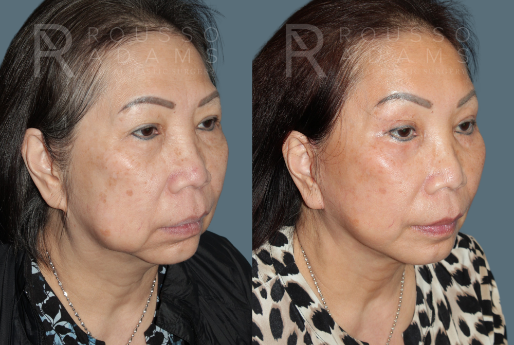 SculptLift™ <span class=small>By Dr. Daniel Rousso</span> Before & After Gallery - Patient 249261 - Image 3