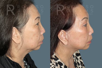 SculptLift™ <span class=small>By Dr. Daniel Rousso</span> Before & After Gallery - Patient 249261 - Image 4