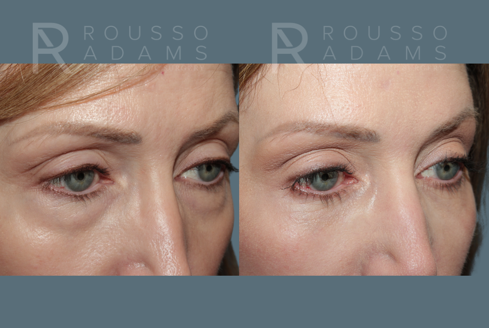 Blepharoplasty<span class=small>By Dr. Austin Adams</span> Before & After Gallery - Patient 384215 - Image 2