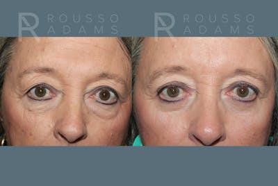 Blepharoplasty<span class=small>By Dr. Austin Adams</span> Before & After Gallery - Patient 386075 - Image 1