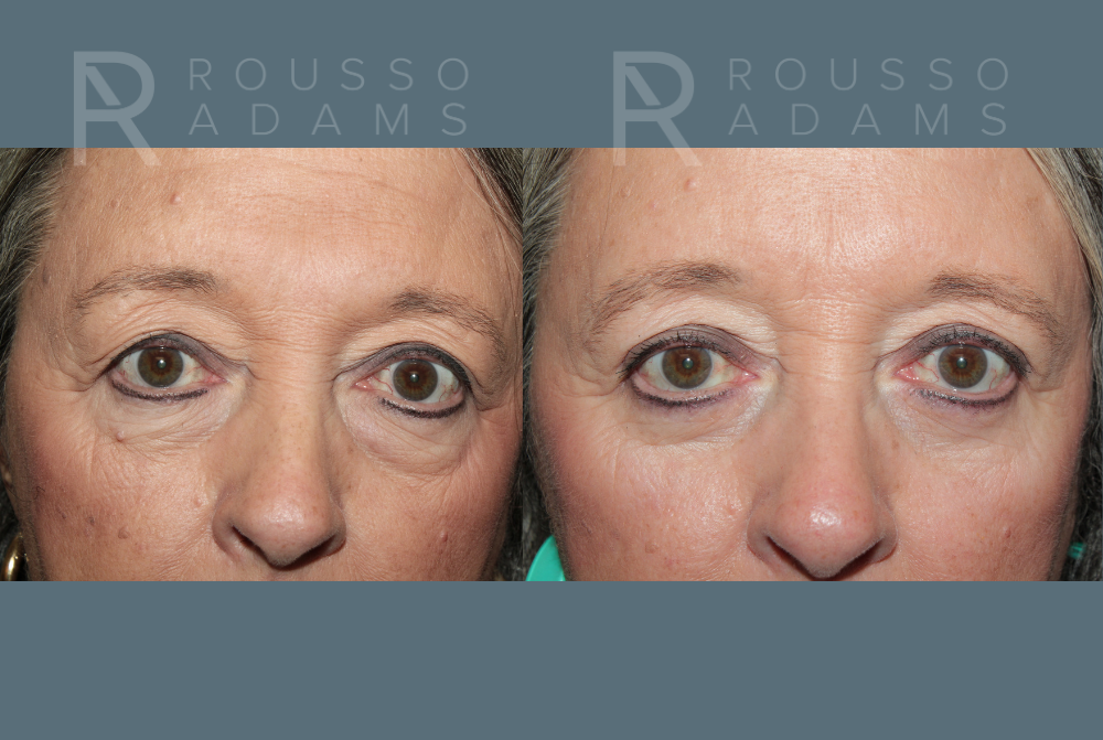 Blepharoplasty<span class=small>By Dr. Austin Adams</span> Before & After Gallery - Patient 386075 - Image 1