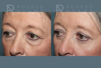 Blepharoplasty<span class=small>By Dr. Austin Adams</span> Before & After Gallery - Patient 386075 - Image 2