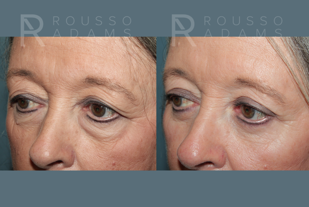 Blepharoplasty<span class=small>By Dr. Austin Adams</span> Before & After Gallery - Patient 386075 - Image 2