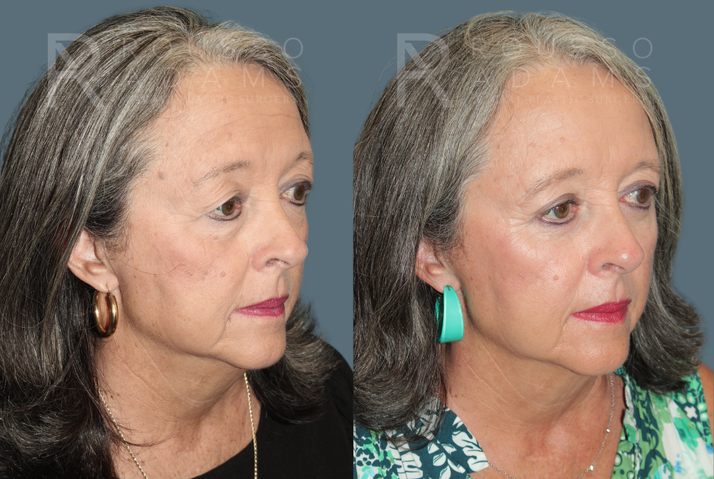 Blepharoplasty<span class=small>By Dr. Austin Adams</span> Before & After Gallery - Patient 386075 - Image 3