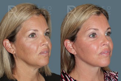Deep Plane Facelift <span class=small>By Dr. Austin Adams</span> Before & After Gallery - Patient 285602 - Image 2