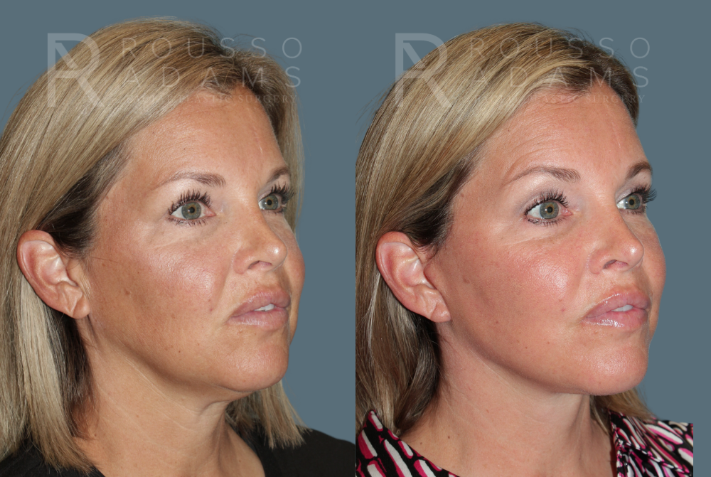Deep Plane Facelift <span class=small>By Dr. Austin Adams</span> Before & After Gallery - Patient 285602 - Image 2
