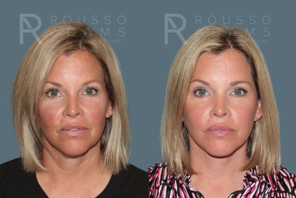 Deep Plane Facelift in Birmingham, AL Before & After Photos