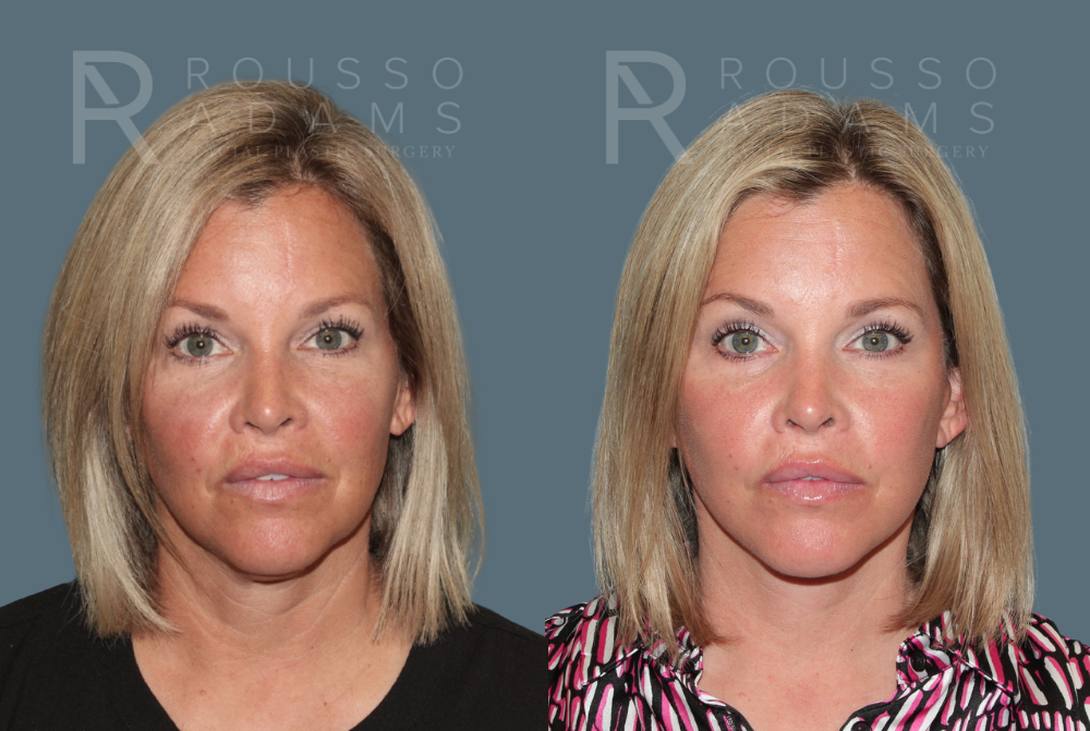 Deep Plane Facelift <span class=small>By Dr. Austin Adams</span> Before & After Gallery - Patient 285602 - Image 1