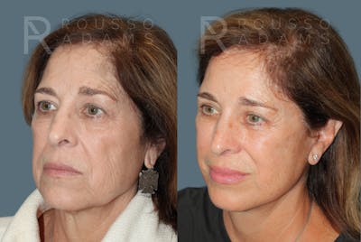 Deep Plane Facelift <span class=small>By Dr. Austin Adams</span> Before & After Gallery - Patient 130854 - Image 2