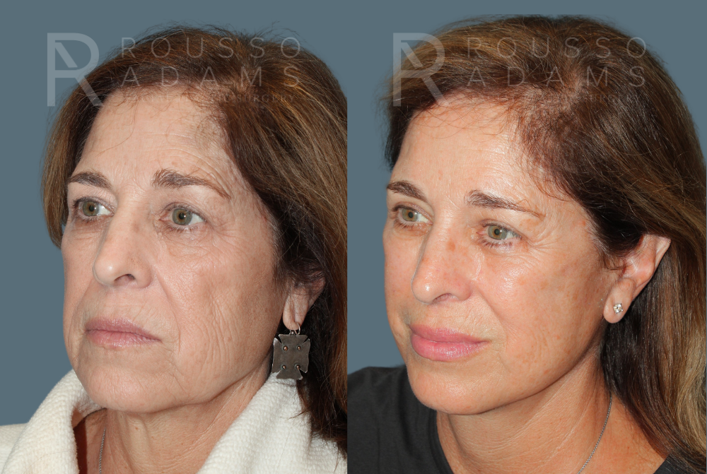 Deep Plane Facelift <span class=small>By Dr. Austin Adams</span> Before & After Gallery - Patient 130854 - Image 2