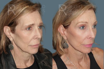 Deep Plane Facelift <span class=small>By Dr. Austin Adams</span> Before & After Gallery - Patient 110064 - Image 1