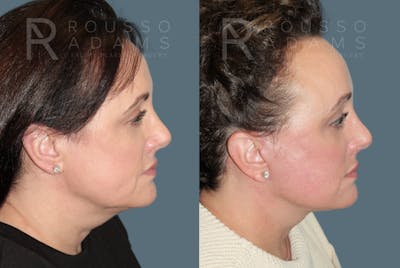 Deep Plane Facelift <span class=small>By Dr. Austin Adams</span> Before & After Gallery - Patient 375926 - Image 2